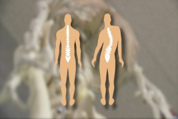 Scoliosis